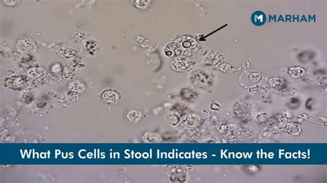 pus cells normal range|PUS Cells in Stool .